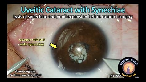 Cataractcoach 1290 Uveitic Cataract With Synechiae Youtube