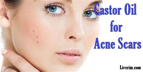 How to use Castor Oil for Acne Scars?