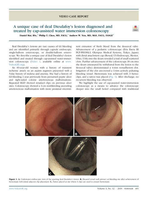 Pdf A Unique Case Of Ileal Dieulafoy S Lesion Diagnosed And Treated By Cap Assisted Water