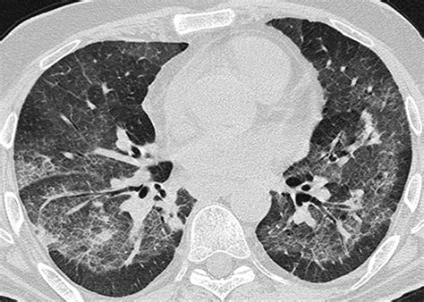 Humane Metapneumovirus Hmpv Associated Pulmonary Infections In Immunocompromised Adults