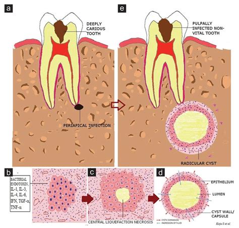 Pathogenesis Of Radicular Cyst A Carious Tooth Showing A Periapical Download Scientific