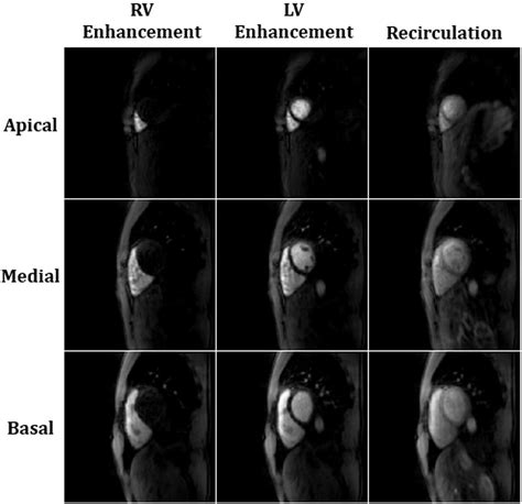 Accelerated 2D Multi Slice First Pass Contrast Enhanced Myocardial