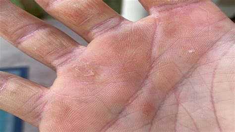 Why Do You Get Calluses On Your Hands YouTube