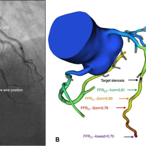 Representative images for invasive FFR and FFRCT measurements. A ICA ...