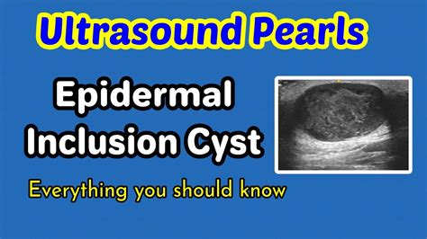 Epidermal Sebaceous Cyst