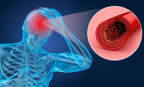 ¿qué Es Un Accidente Cerebrovascular Fundación Best