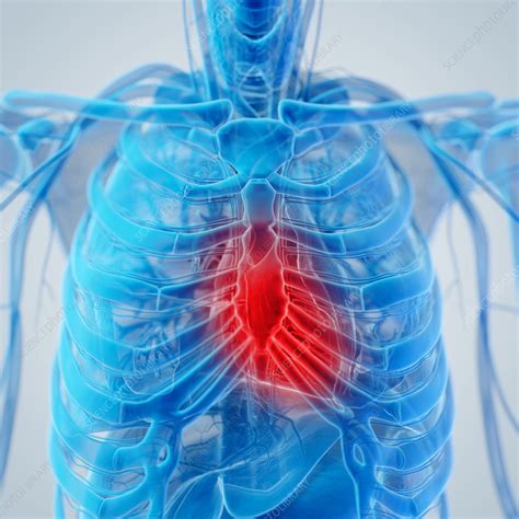 Inflamed Heart Illustration Stock Image F0384306 Science Photo