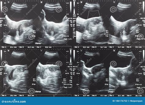 Ultrasound Image Of Lower Abdomen Ovary And Uterus With Tumor Or