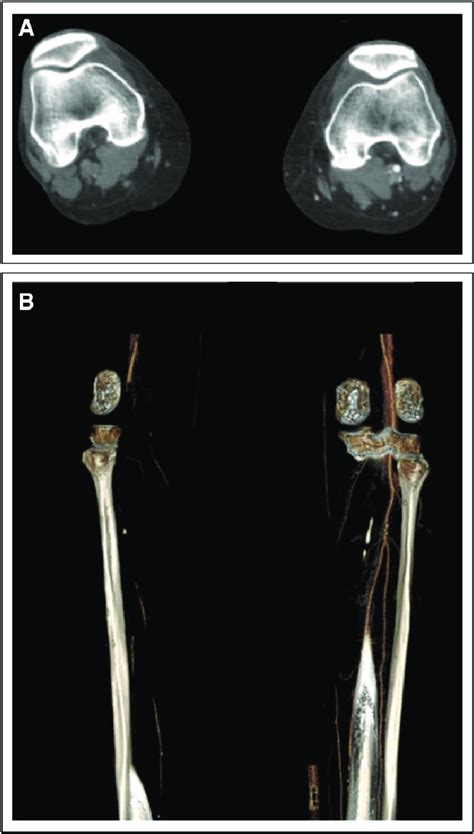 Ct Angiogram Of Bilateral Lower Extremities A Axial Ct Angiogram Download Scientific Diagram