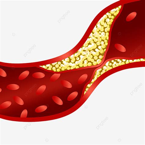 Blood Cholesterol PNG Picture Blood Vessel Blockage Cholesterol