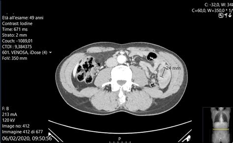 Frontiers Small Bowel Intussusception Due To Rare Cardiac Intimal