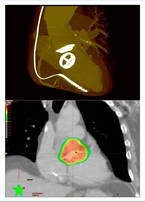 Successful Noninvasive Lead Ecg Mapping Guided Radiotherapy Of