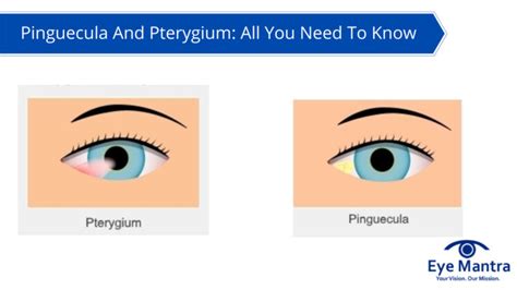 Pinguecula And Pterygium All You Need To Know Eyemantra Hospital