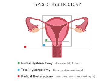 vaginal hysterectomy cpt code