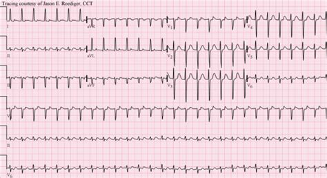 Sinus Tachycardia Ecg Guru Instructor Resources