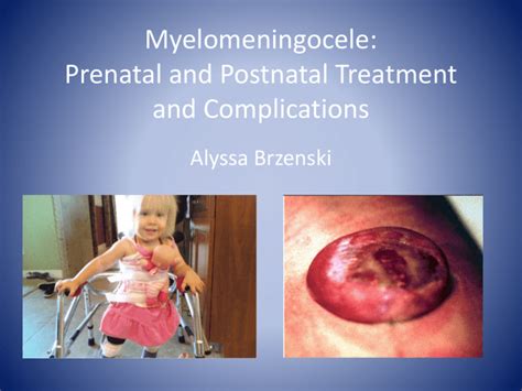 Myelomeningocele: Prenatal and Postnatal Treatment and