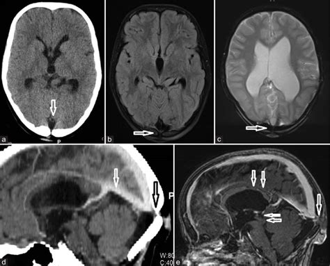 Case Plain Ct Axial A Mri Fluid Attenuated Inversion Recovery