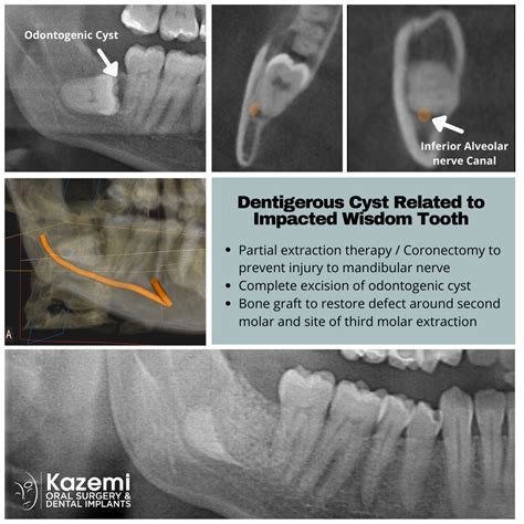 Partial Extraction Therapy Coronectomy For Treatment Of An