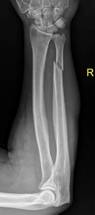 Isolated Ulna Shaft Fracture Radiology Case Radiopaedia Org