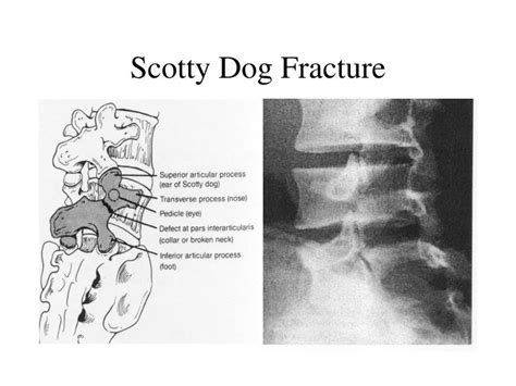 Ppt Spondylolysis And Spondylolisthesis Powerpoint Presentation Id