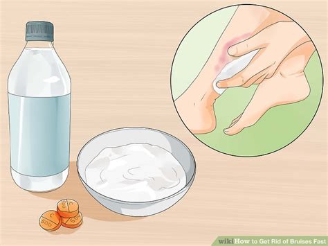 How To Get Rid Of Bruises Fast Steps With Pictures Wikihow