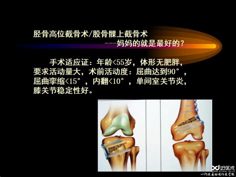 膝关节骨性关节炎的阶梯治疗策略看这里