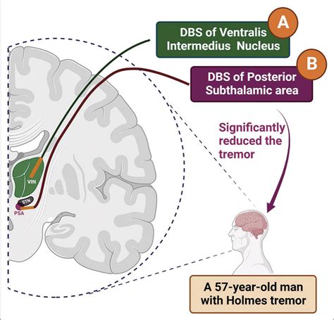 Surgical Neurology International