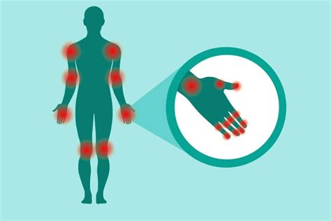 Rheumatoid Arthritis Symptoms You Might Be Ignoring