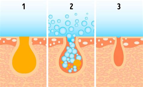 Why Large Pores Appear And How To Get Rid Of Them Without Undergoing