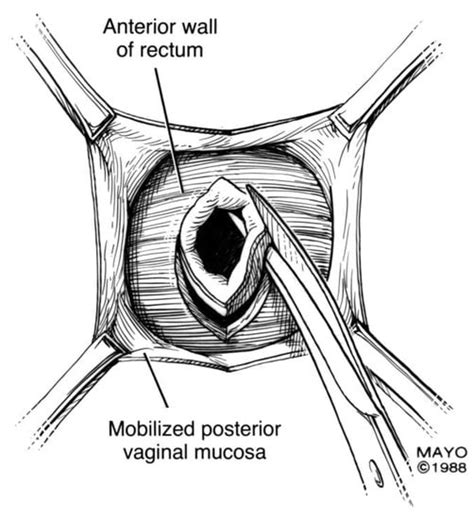 Colorectal Vaginal Fistulas Imaging And Novel Interventional Treatment