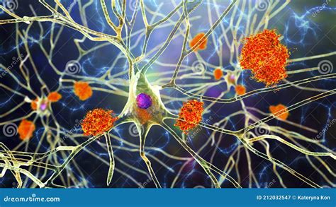 Las Neuronas En La Enfermedad De Los Alzheimers Stock De Ilustración Ilustración De Senil