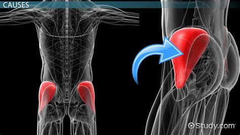 Gluteus Medius Tear Symptoms Diagnosis And Treatment Lesson