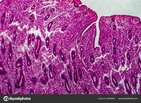 Endometrial Hyperplasia Light Micrograph Photo Microscope Stock Photo