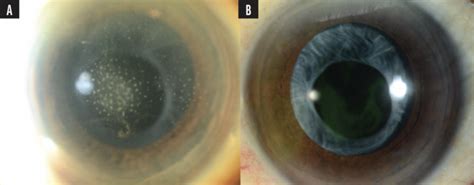 Treating Herpes Simplex And Varicella Anterior Uveitis Youngmd Connect