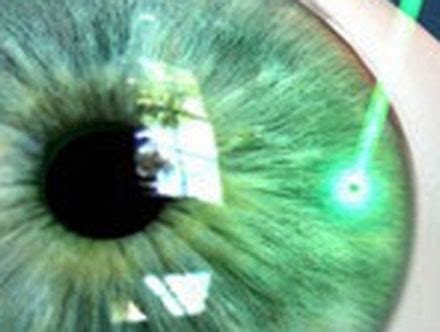 Iridotomia Laser Yag Laser Pronto Cl Nica De Olhos