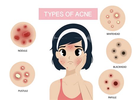 Acne Vulgaris: Causes, Types, and Specialized Treatment | Maple Clinic