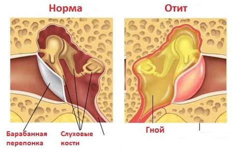 Диффузный наружный отит: симптомы и лечение у взрослых, фото