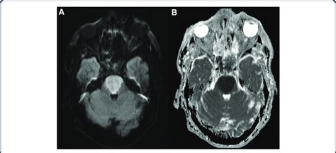 Axial Magnetic Resonance Images A Diffusion Weighted Image Dwi Download Scientific Diagram