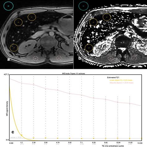 Pdf Practical Guide To Quantification Of Hepatic Iron With Mri