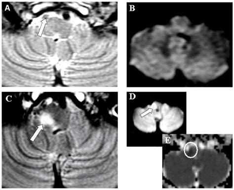 Axial T2 Weighted And Diffusion Weighted Images A And B Axial