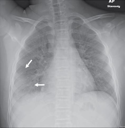 Atypical Pneumonia X Ray