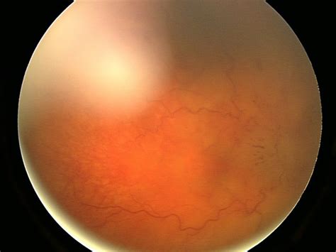 Pseudo Foster Kennedy Syndrome Due To Unilateral Optic Nerve Hypoplasia