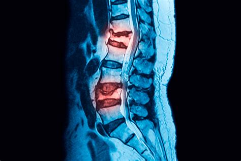 Fracturas Osteopor Ticas Patolog A De La Columna Vertebral