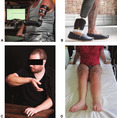 State Of The Art Prosthetic Devices A Johns Hopkins Applied Physics Download Scientific