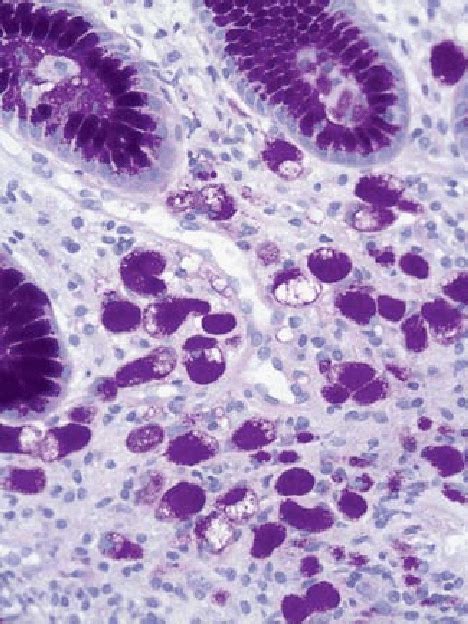 Intramucosal Signet Ring Cell Gastric Adenocarcinoma With Periodic Acid