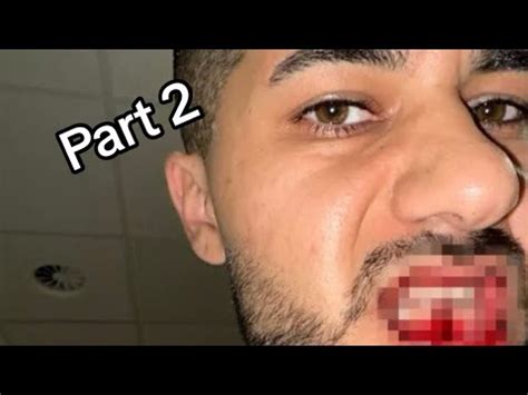 Hamed Nimmt Drogen Gegen Den Schmerz Kieferbruch Part 3 YouTube