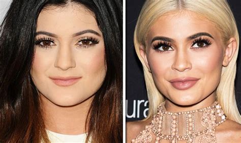 Kylie Jenner Plastic Surgery Before And After Kylie Jenner Plastic Surgery Plastic Surgery