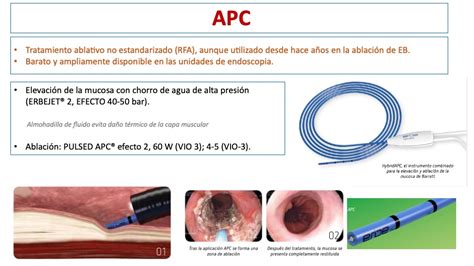 Ablación del esófago de Barrett con el sistema Hybrid APC 2