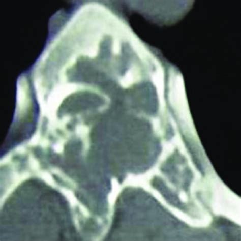 Ct Scan Of The Lesion Download Scientific Diagram