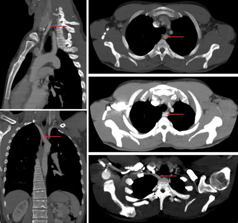 Left Aortic Arch With Aberrant Right Subclavian Computed Tomography